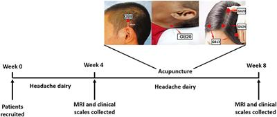 Baseline Brain Gray Matter Volume as a Predictor of Acupuncture Outcome in Treating Migraine